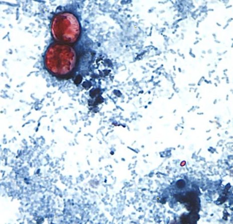 Why cyclospora can be deadly for some people