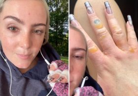 NYC woman warns against getting painful, blistering  ‘Margarita Burn’ by avoiding this common summer activity