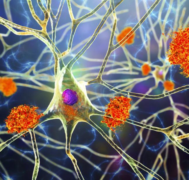 New blood test for Alzheimer’s disease gets FDA approval