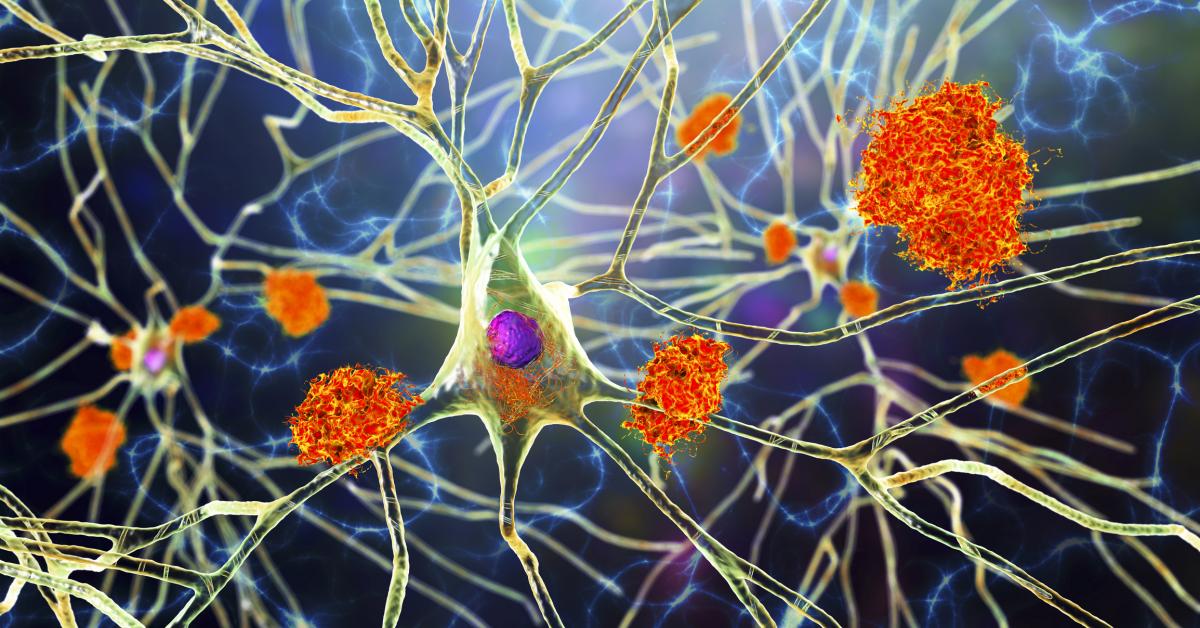 New blood test for Alzheimer's disease gets FDA approval GettyImages 1328334584
