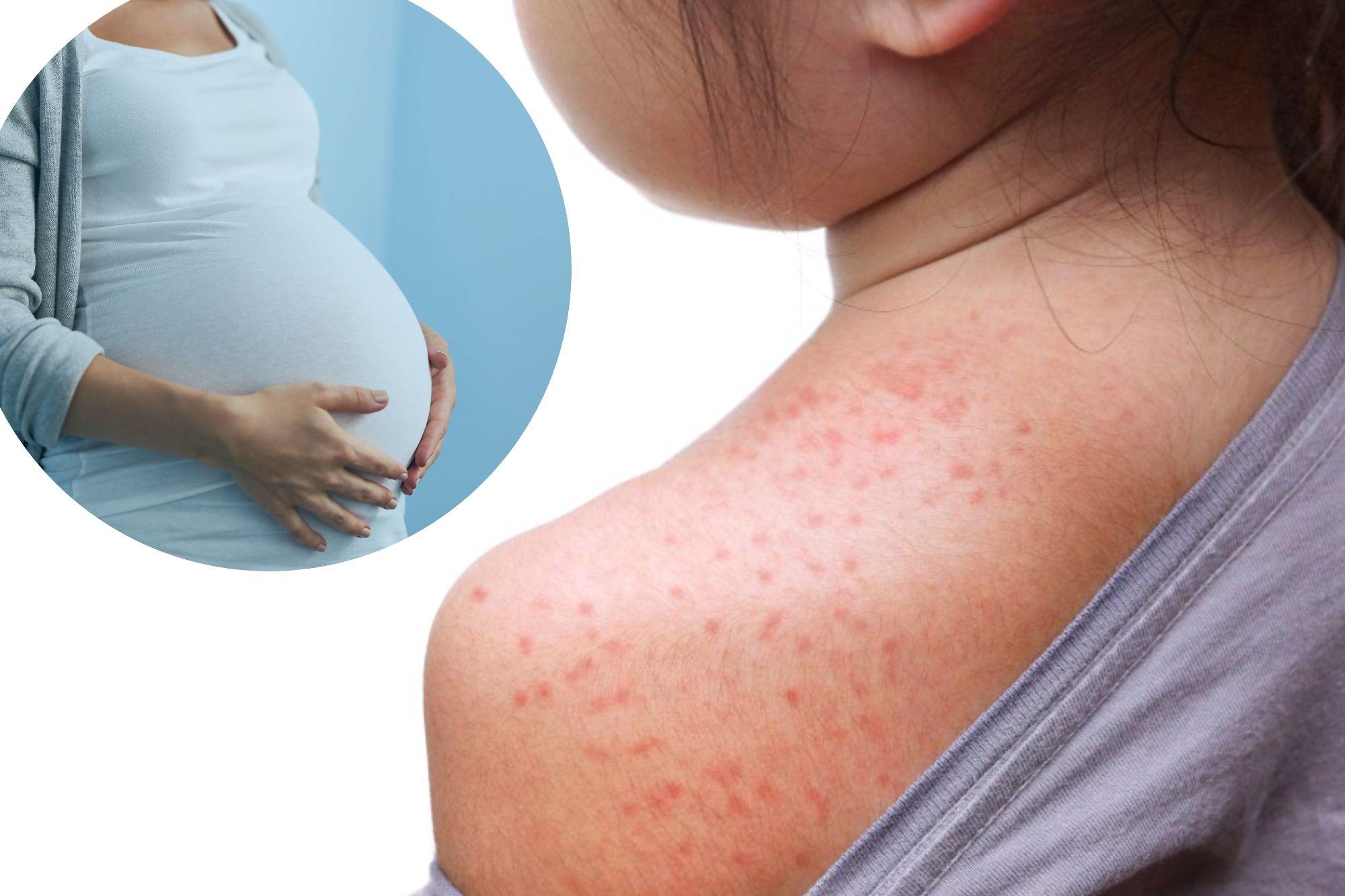 ‘We’re literally seeing new forms of measles’: Infectious disease doc warns about scary Pennsylvania development newspress collage hn5b4j6dy 1790175895527