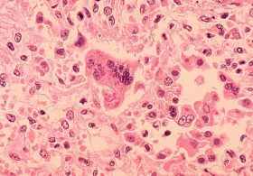 Fort Wayne Zoo Measles Alert: Visitors Urged To Check Vaccines After September 27 Exposure