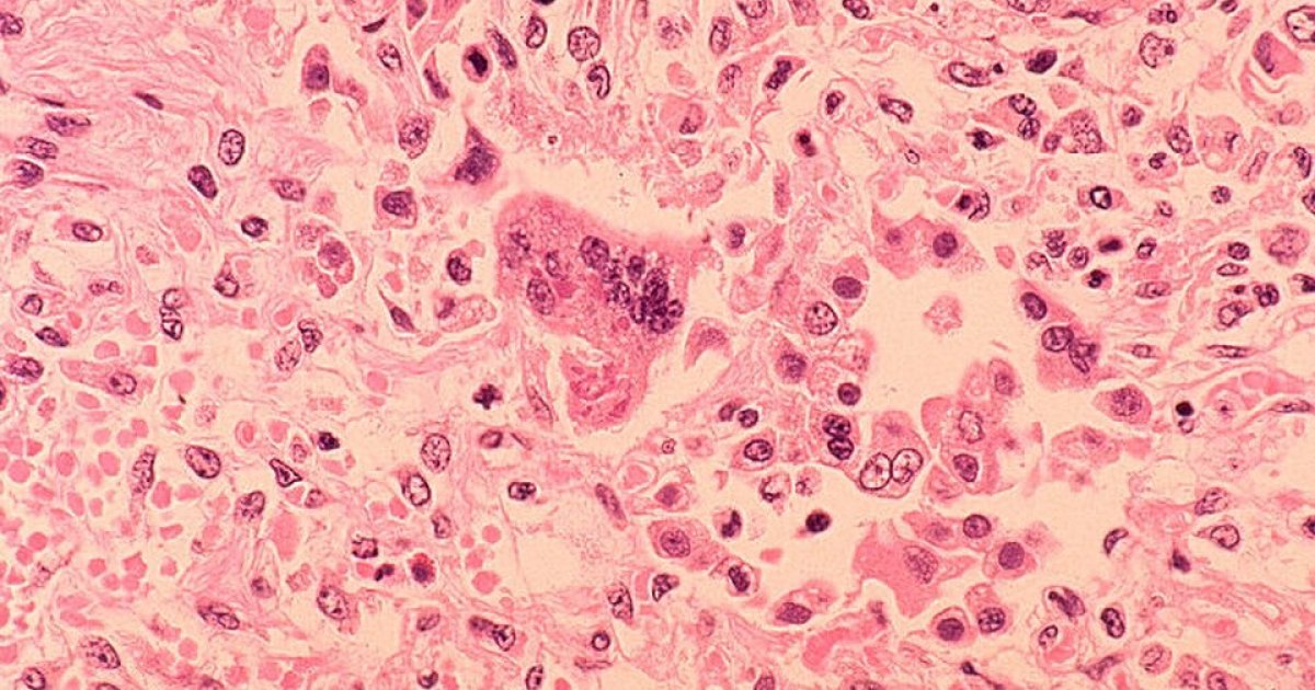 Fort Wayne Zoo Measles Alert: Visitors Urged To Check Vaccines After September 27 Exposure measles
