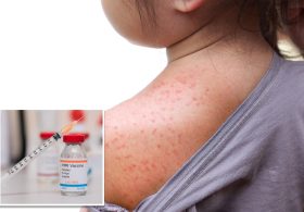 NY declares state disaster emergency over measles outbreak in rural communities