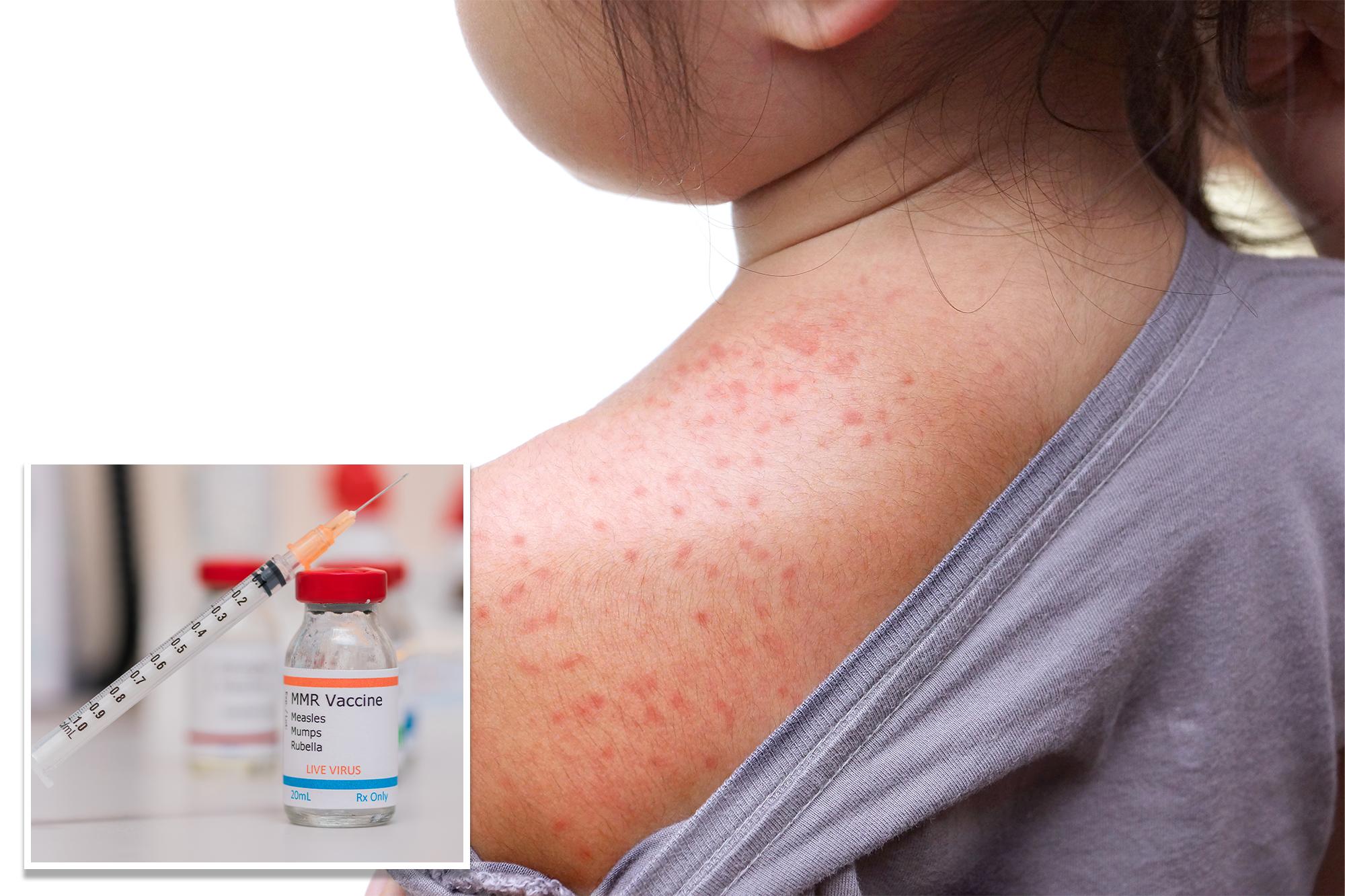 NY declares state disaster emergency over measles outbreak in rural communities ny declares state disaster emergency 143906695