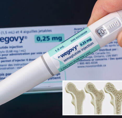 Ozempic and Wegovy may strengthen bones in Type 2 diabetes patients, study finds