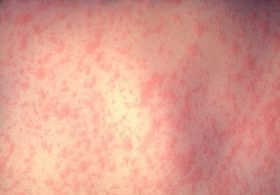 New York launches tracker as measles cases hit 57