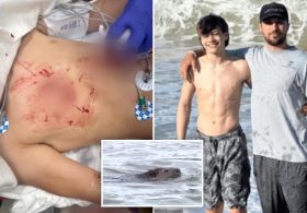 Boy, 13, attacked by rabid beaver at Maryland state park undergoes multiple surgeries
